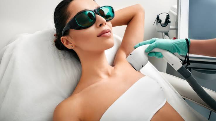 Candela Laser Hair Removal