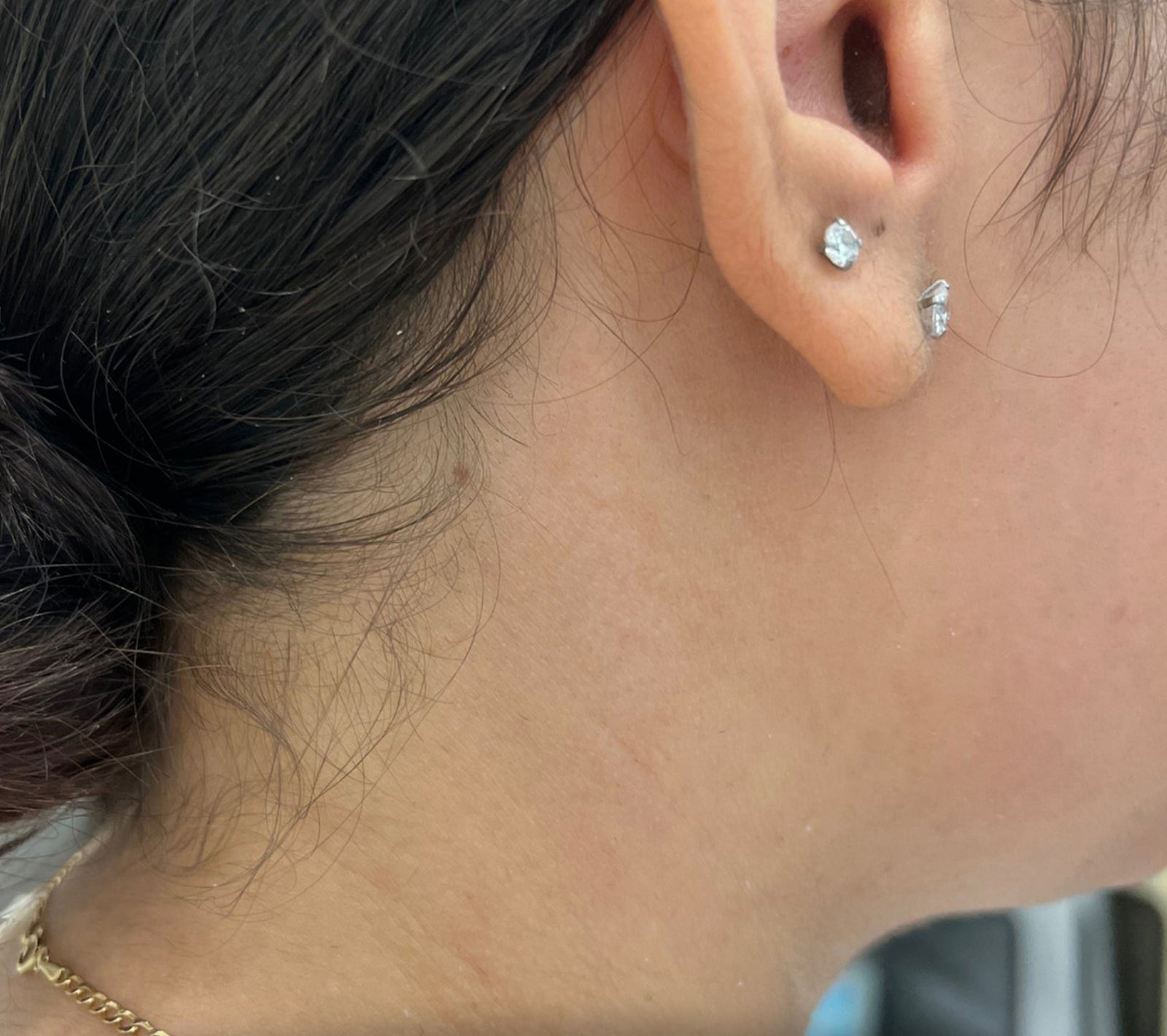 After Candela Gentle Pro laser hair removal showing smooth, hair-free skin near ear and sideburn area