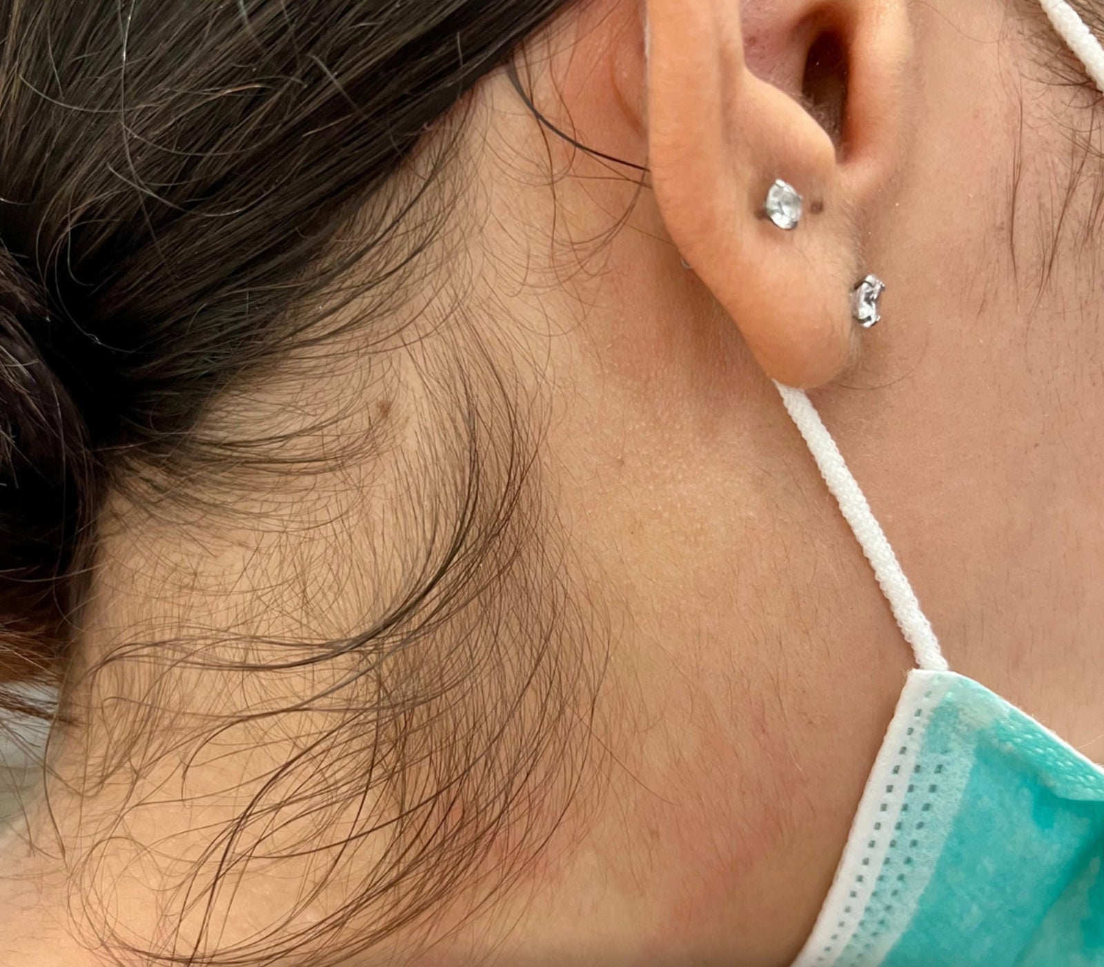 Before Candela Gentle Pro laser hair removal showing visible sideburn and facial hair near ear